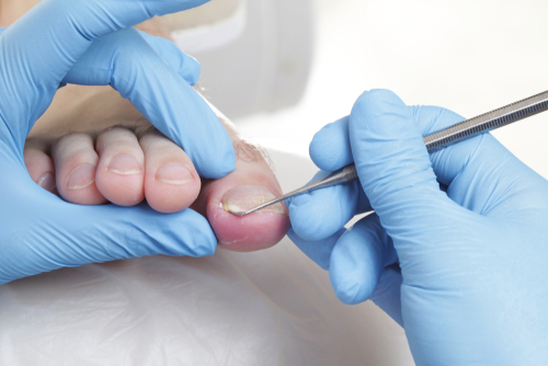 Druckstellen und Hühneraugen